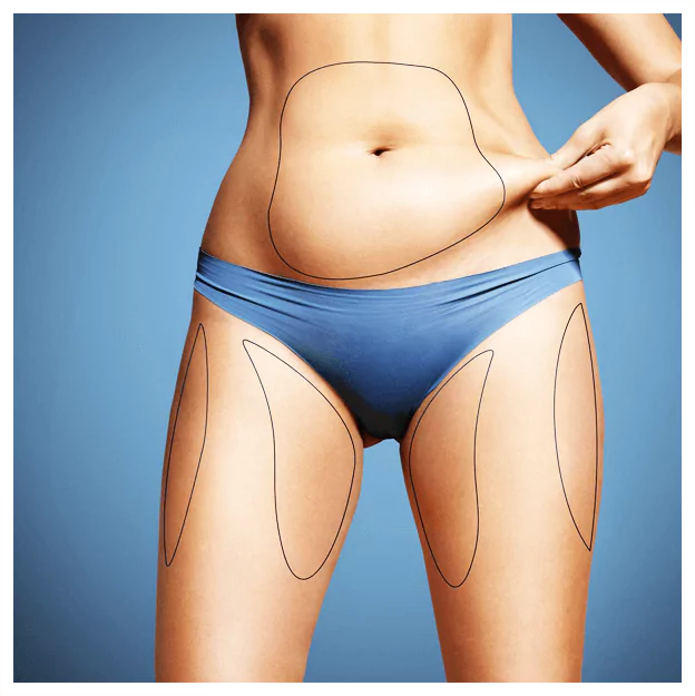 Common Treatment Areas for Liposuction